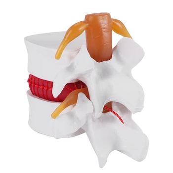 Демонстрационен модел Херния на Лумбалните диск Човек 1:1.5 Модел на Лумбалния отдел на гръбначния Стълб За Анатомията на човека